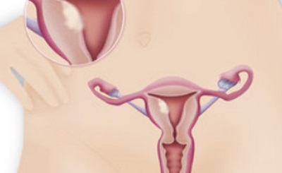 endometrio